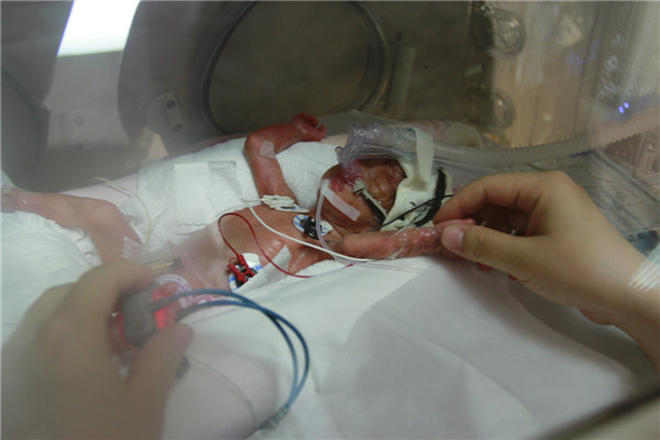Palm-size baby born in C China