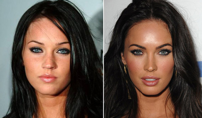 Worst celebrity plastic surgery fails