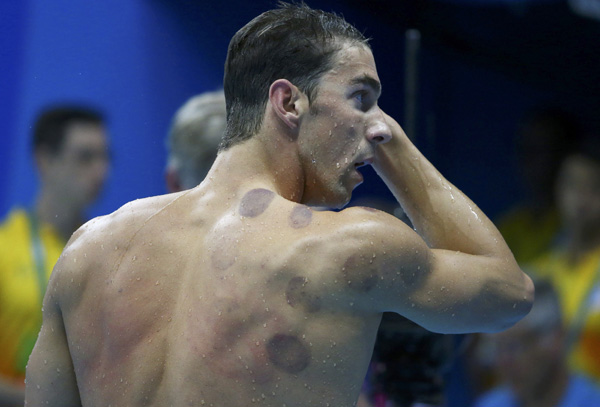 Cupping and coining: I did it long before Michael Phelps did in Rio
