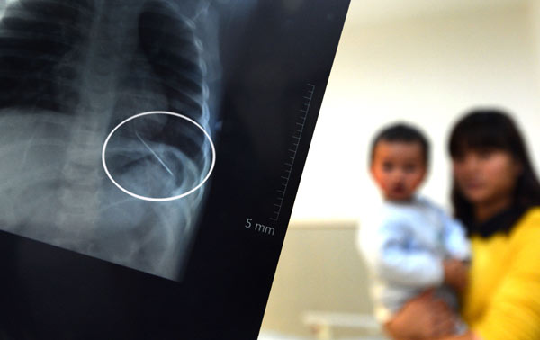 X-ray reveals crying toddler had 5-cm needle inserted in his lung